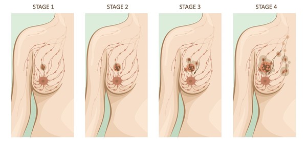 유방암 2기 생존율
