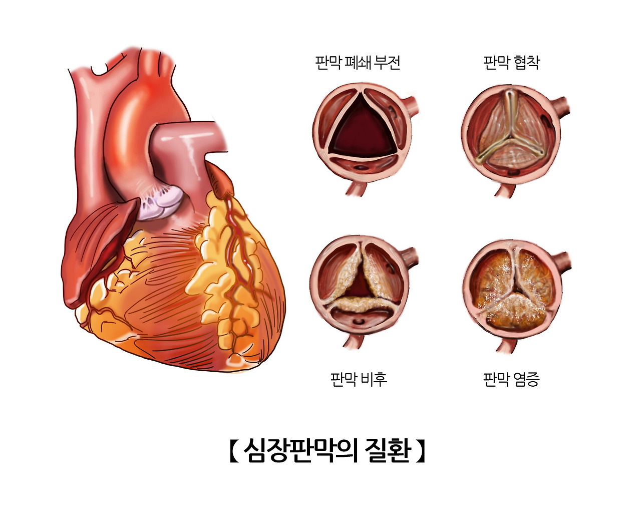 심장판막증 증상