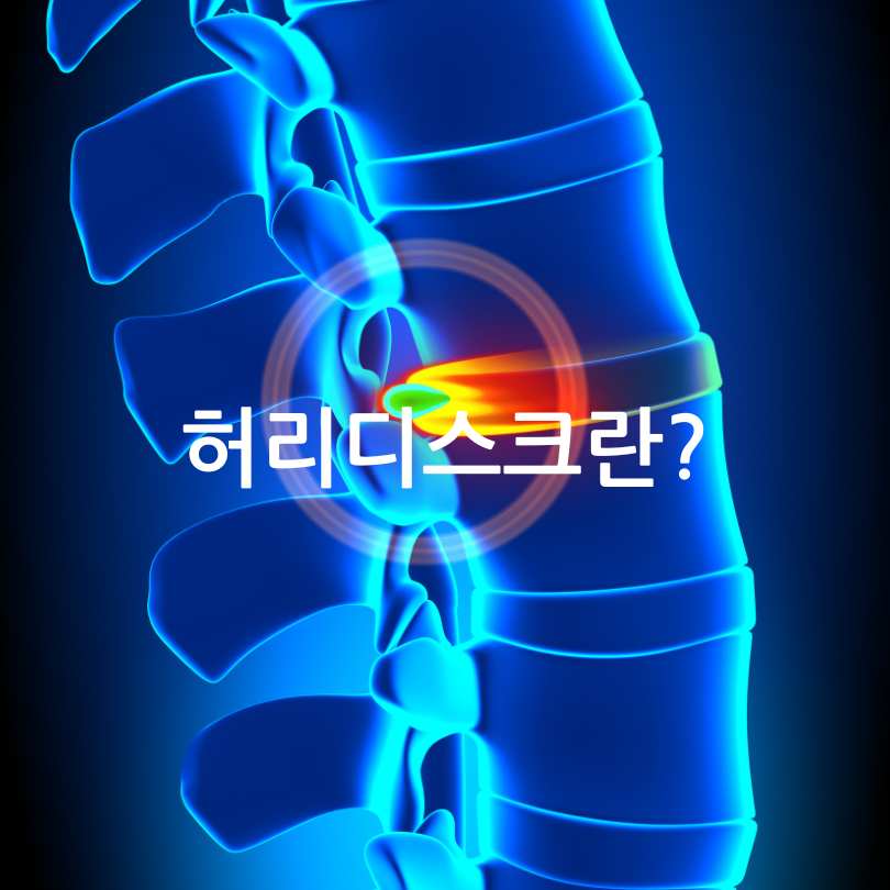 허리디스크와 허리 협착증의 차이점