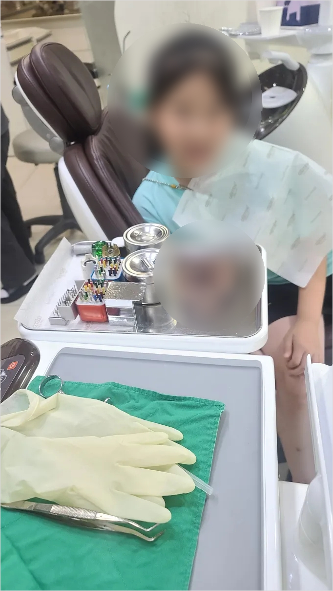 유치 어금니 홈메우기