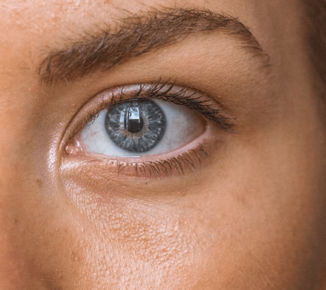 모공각화증 치료방법 - 연고 / 크림