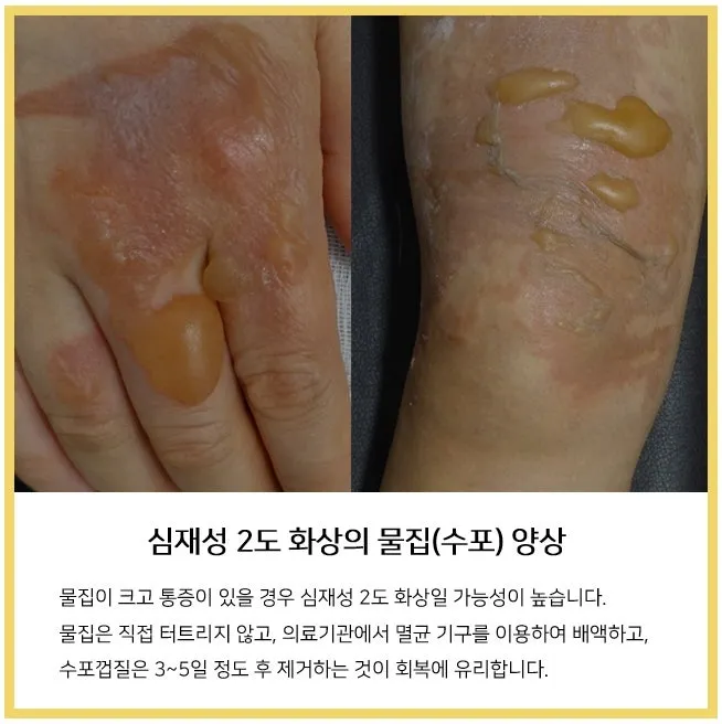 2도 화상 증상 자가치료 회복기간 응급처치법 정리_3