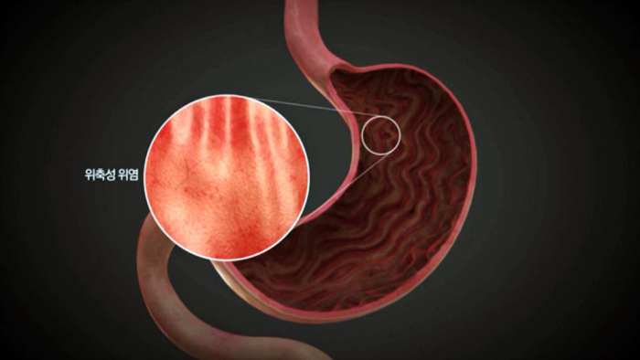 명의-위염-만성위염-장상피화생-위암-위축성위염