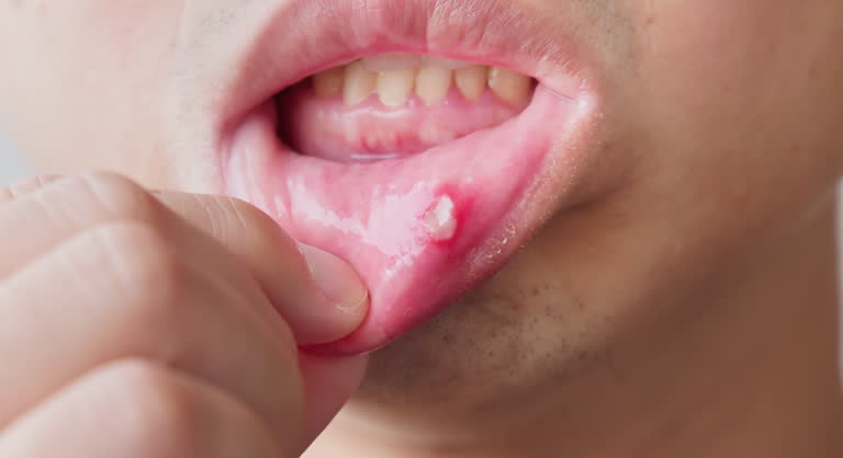 베체트병의 주요 초기증상 중에 입안 궤양 구내염