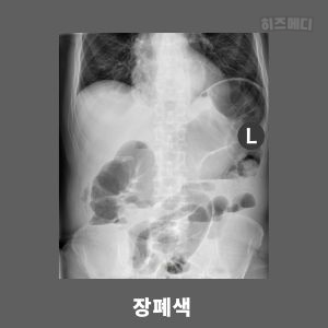 배에 가스가 자주 차는 이유