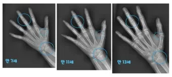 성장판 닫혀도 키 클 수 있는 방법과 성장 호르몬 시기_19