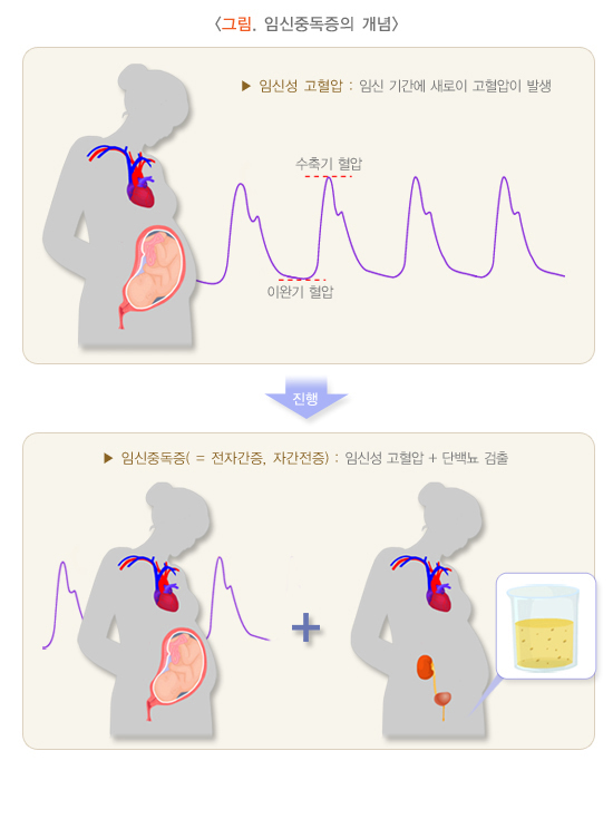 임신중독증 개념
