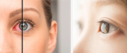 안구건조증/출처:어도비스톡