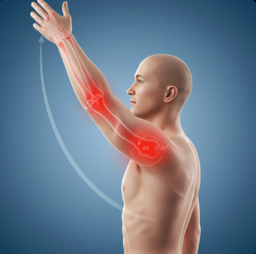 회전근개파열 증상 및 치료법5