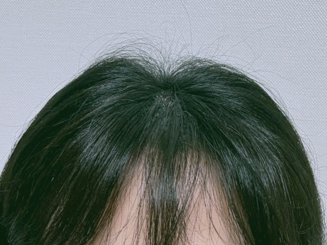 탈모샴푸 추천