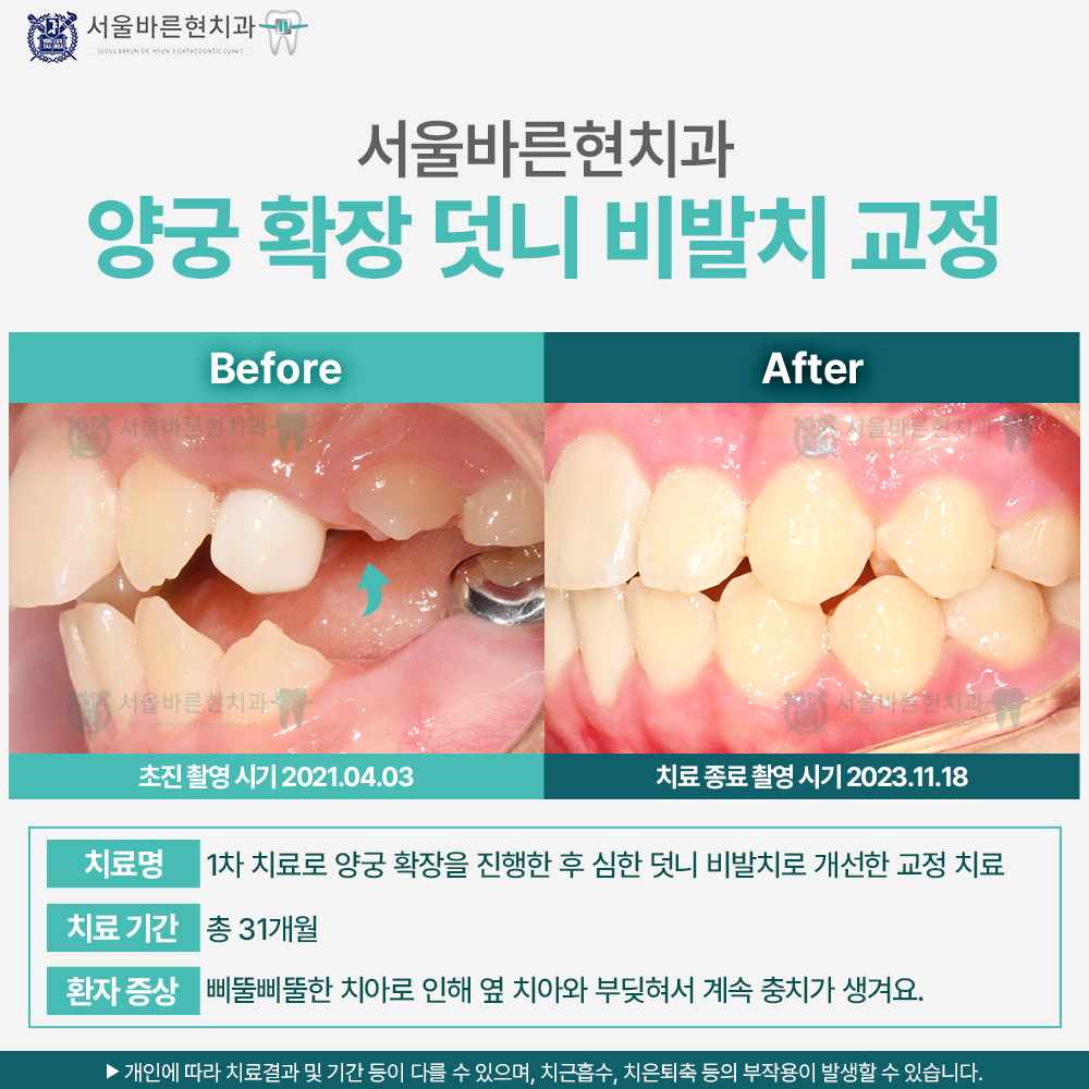 마린시티치아교정