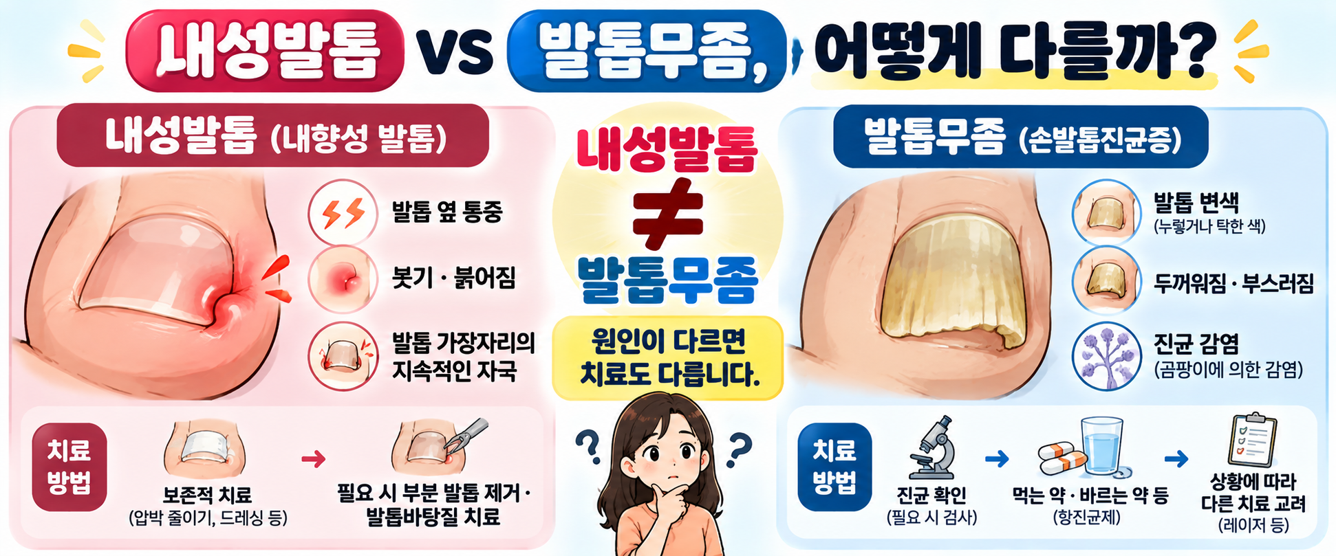 내성발톱의 발톱 옆 통증과 발톱무좀의 변색 두꺼워짐 등 증상과 치료 차이를 설명하는 인포그래픽