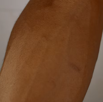 두드러기 치료방법 진단 기준 합병증