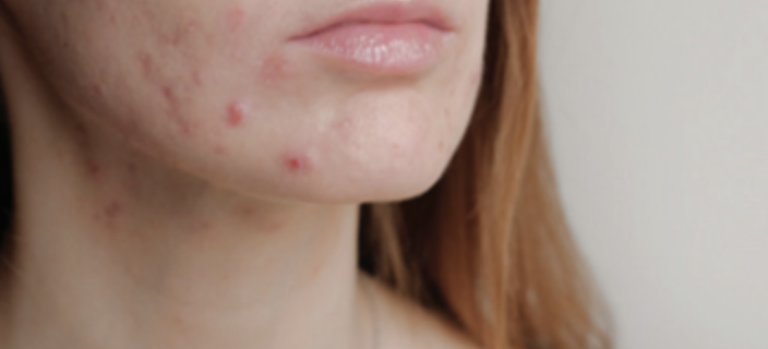 마스크네 VS 일반 여드름 차이와 관리 방법 사진