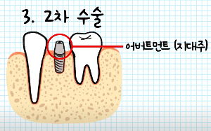 2차 수술