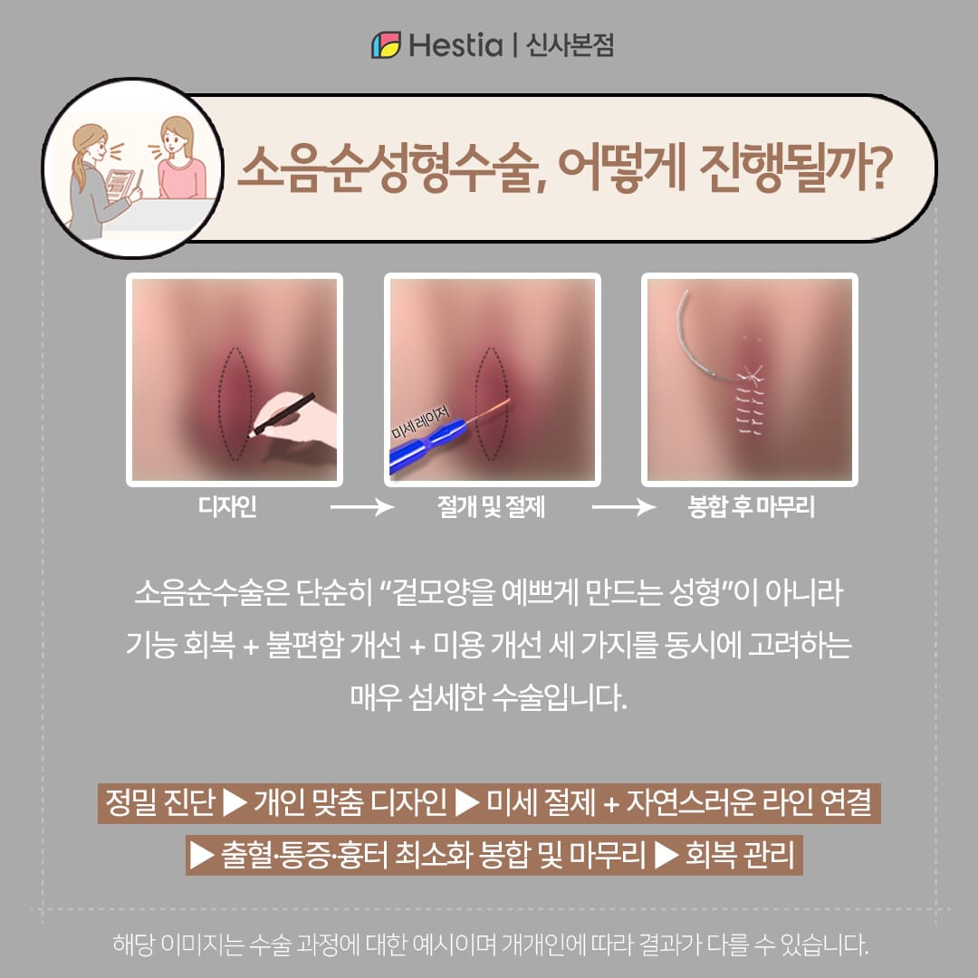 소음순성형수술은 어떻게 진행될까?