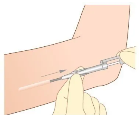 임플라논-삽입-위치