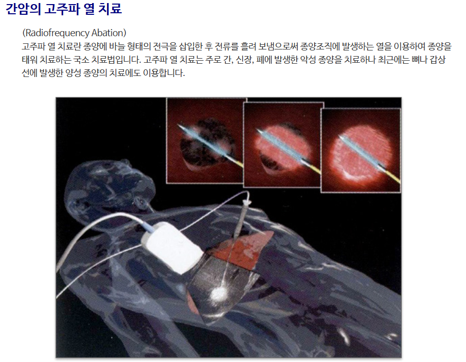 간암의 고주파 열치료(RFA : Radiofrequency Abation)