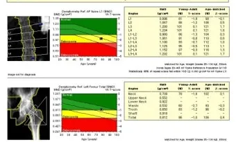 골밀도 검사 수치 골밀도 높이는 방법 간단 정리_10
