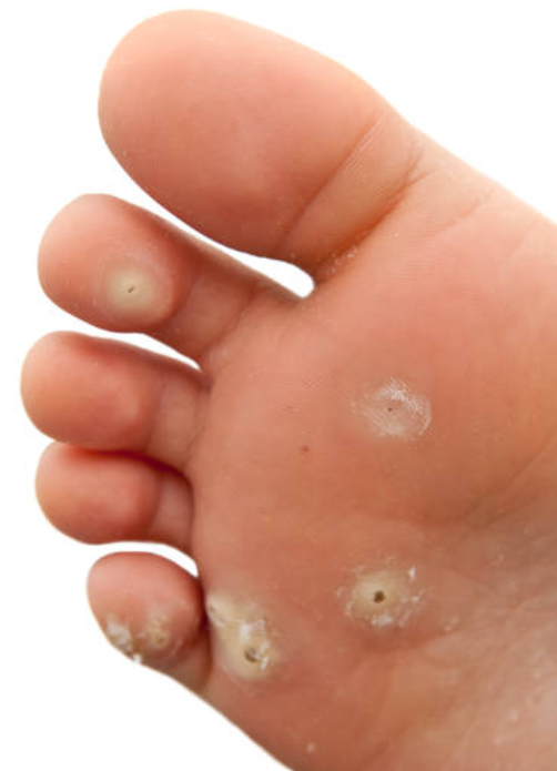 발바닥 사마귀 사진