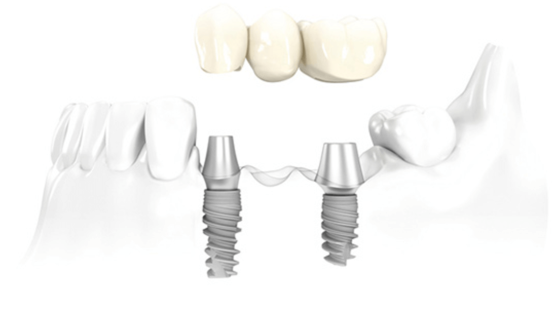 임플란트 브릿지