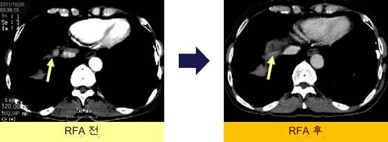 간암 라디오파 소작술