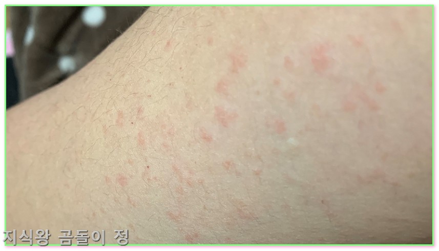 온몸 간지러움 전신 가려움증 두드러기 피부장벽 관리와 보습 루틴 꿀팁3
