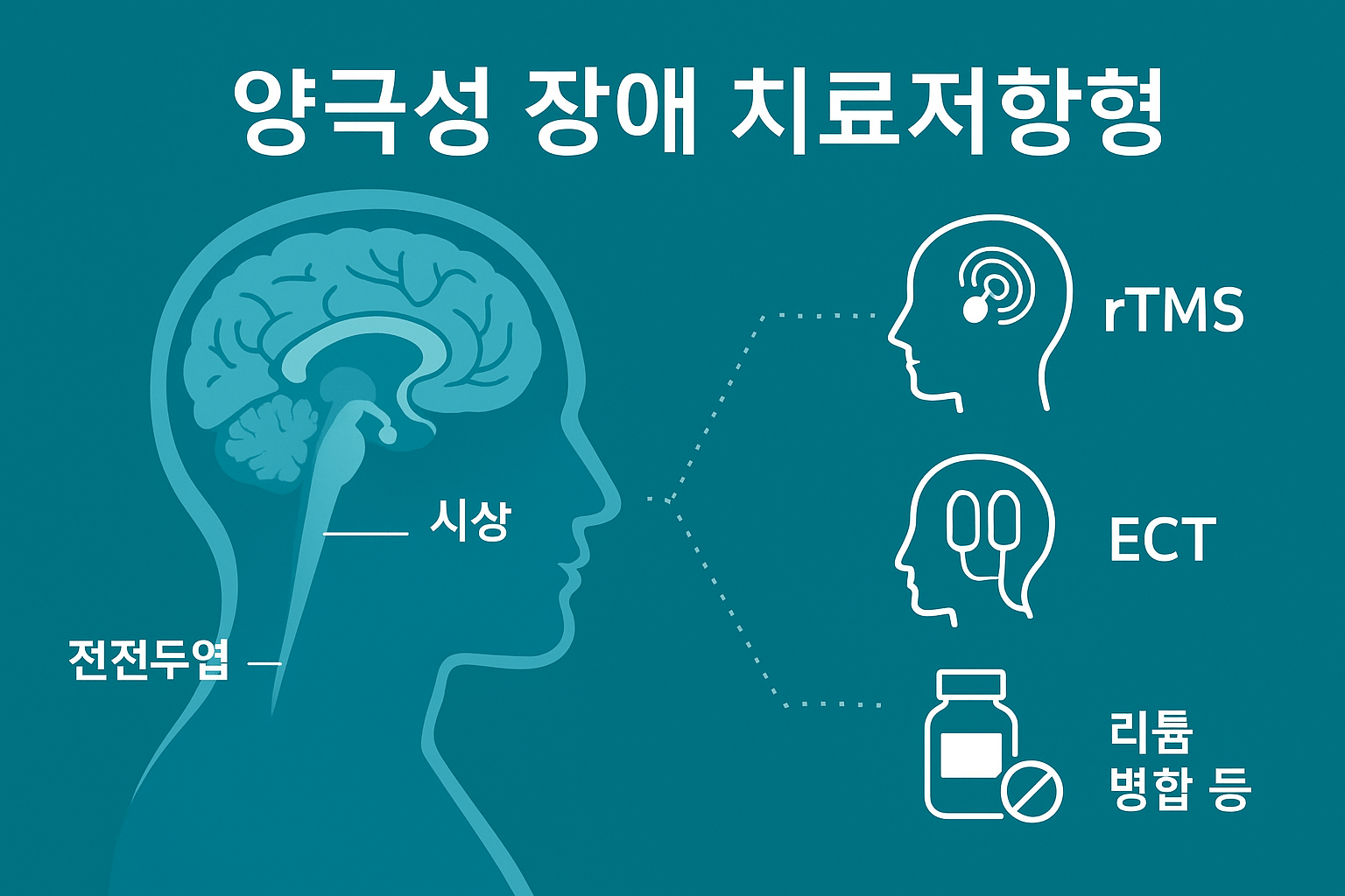 양극성 장애(치료저항형)