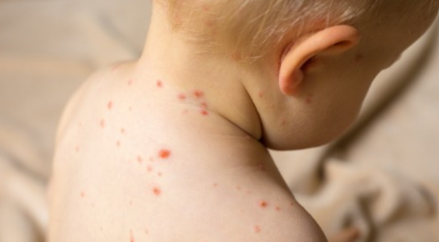 홍역에 걸린 유아