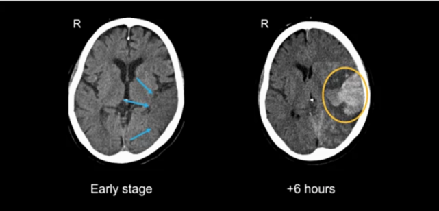  뇌경색 전조증상 확인법과 FAST 자가진단 및 골든타임 예방 관리 가이드