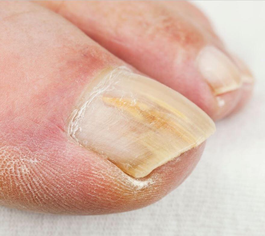 발톱 무좀 증상