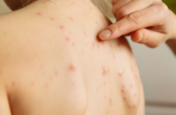 대상포진 예방효과 싱그릭스