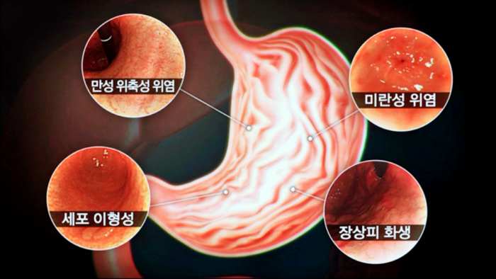 명의-위염-만성위염-장상피화생-위암-종류