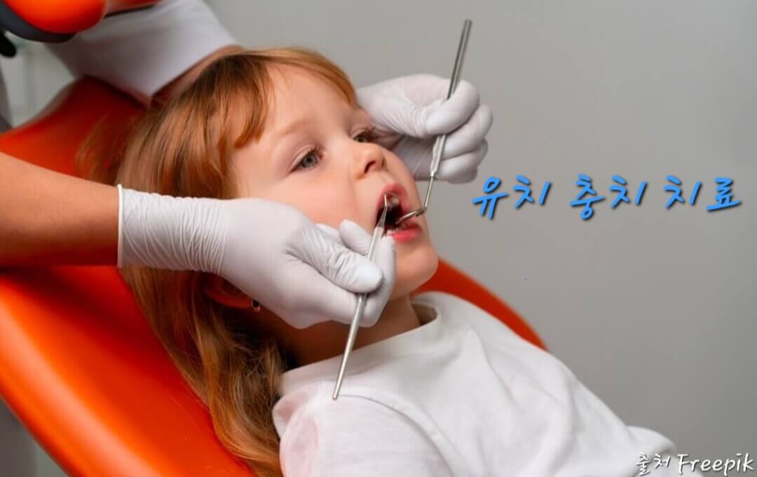 소아 치과 치료