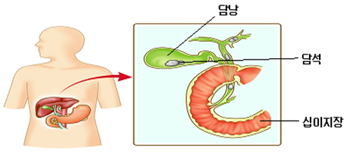 담석