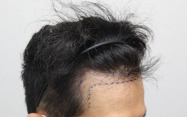 비절개 모발이식 M자 수술 전