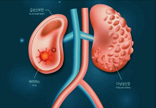신부전증 투석이나 신장이식