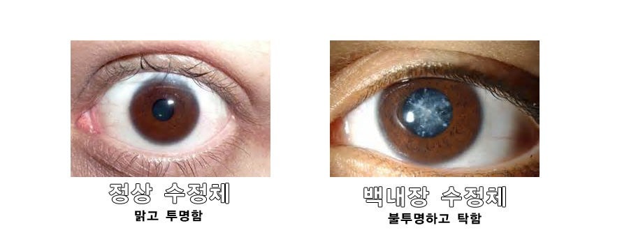 백내장 vs 녹내장, 조기 관리가 정말 중요합니다 관련 사진