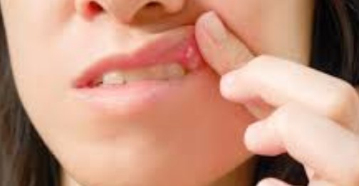 헤르페스 1형 이기는 방법