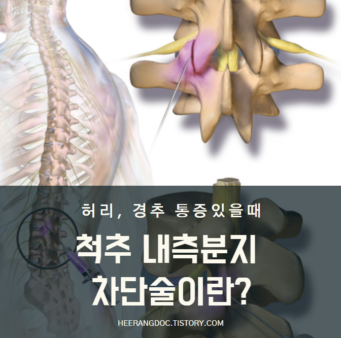 내측분지 차단술이란?