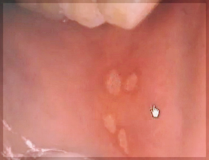 아기구내염-입안수포사진