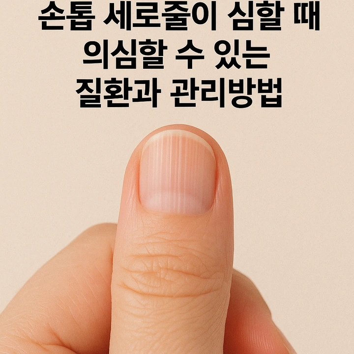 손톱세로줄질환관리방법