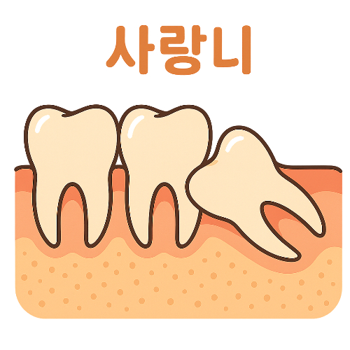 사랑니-발치후-입냄새-없애는법