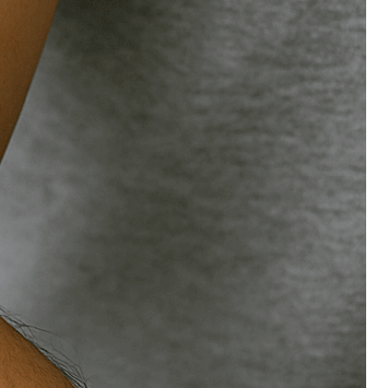 콜린성 두드러기