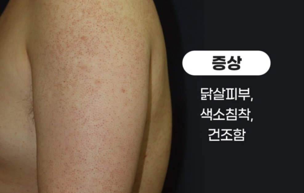 모공각화증 피부 증상