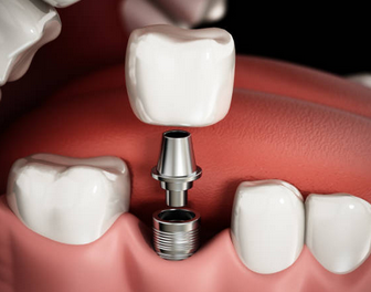 임플란트 시술과정