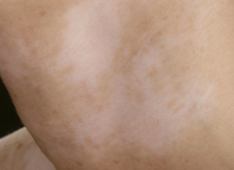 백반증 초기증상 1