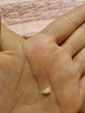 삼겹살-먹다가-이빨이-부러진것을-손바닥에-올려놓은-모습