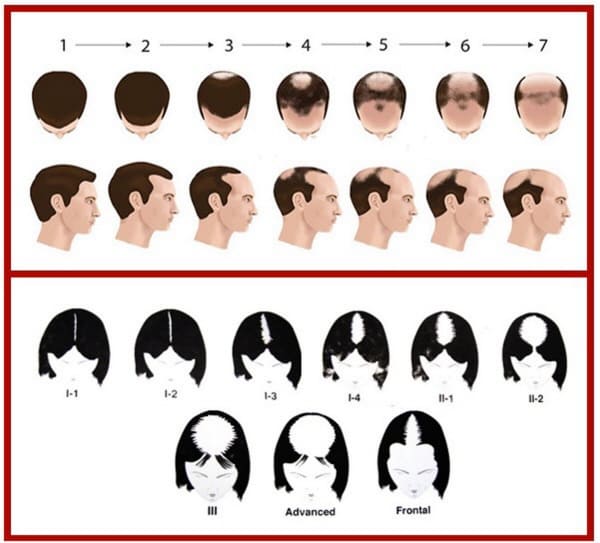 안드로겐성탈모