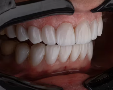 임플란트 시술과정 시술기간 시술 종류